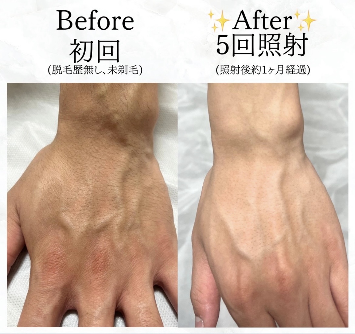 【メンズ】Before／After 手の甲脱毛