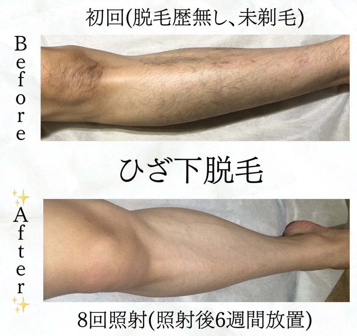 【メンズ】Before／After ひざ下脱毛
