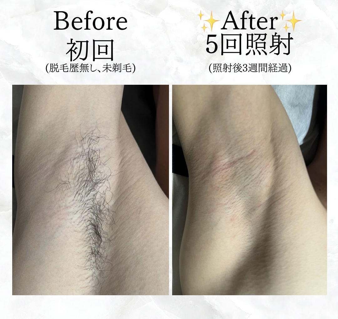 【メンズ】Before／After 脇・ワキ脱毛