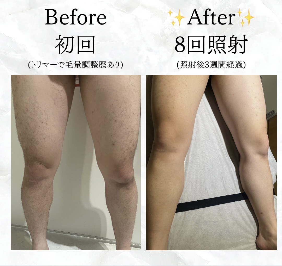 【メンズ】Before／After 脚/足脱毛