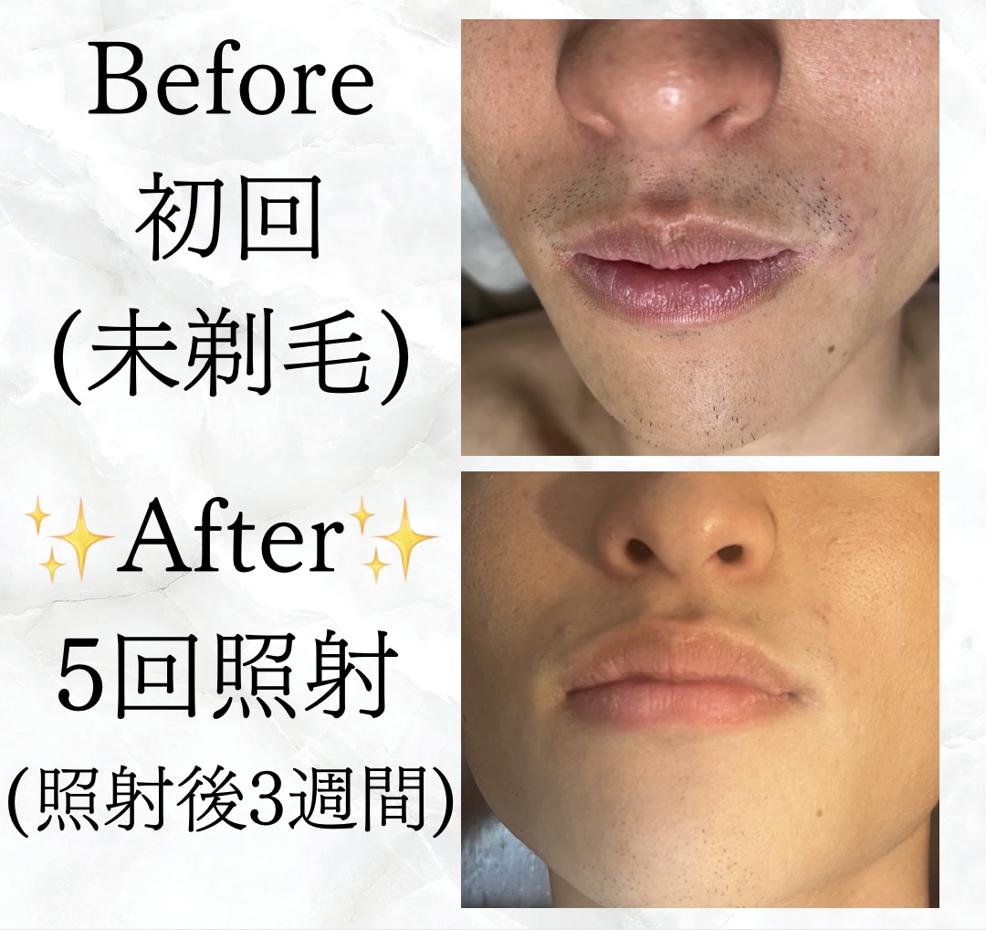【メンズ】Before／After ヒゲ脱毛