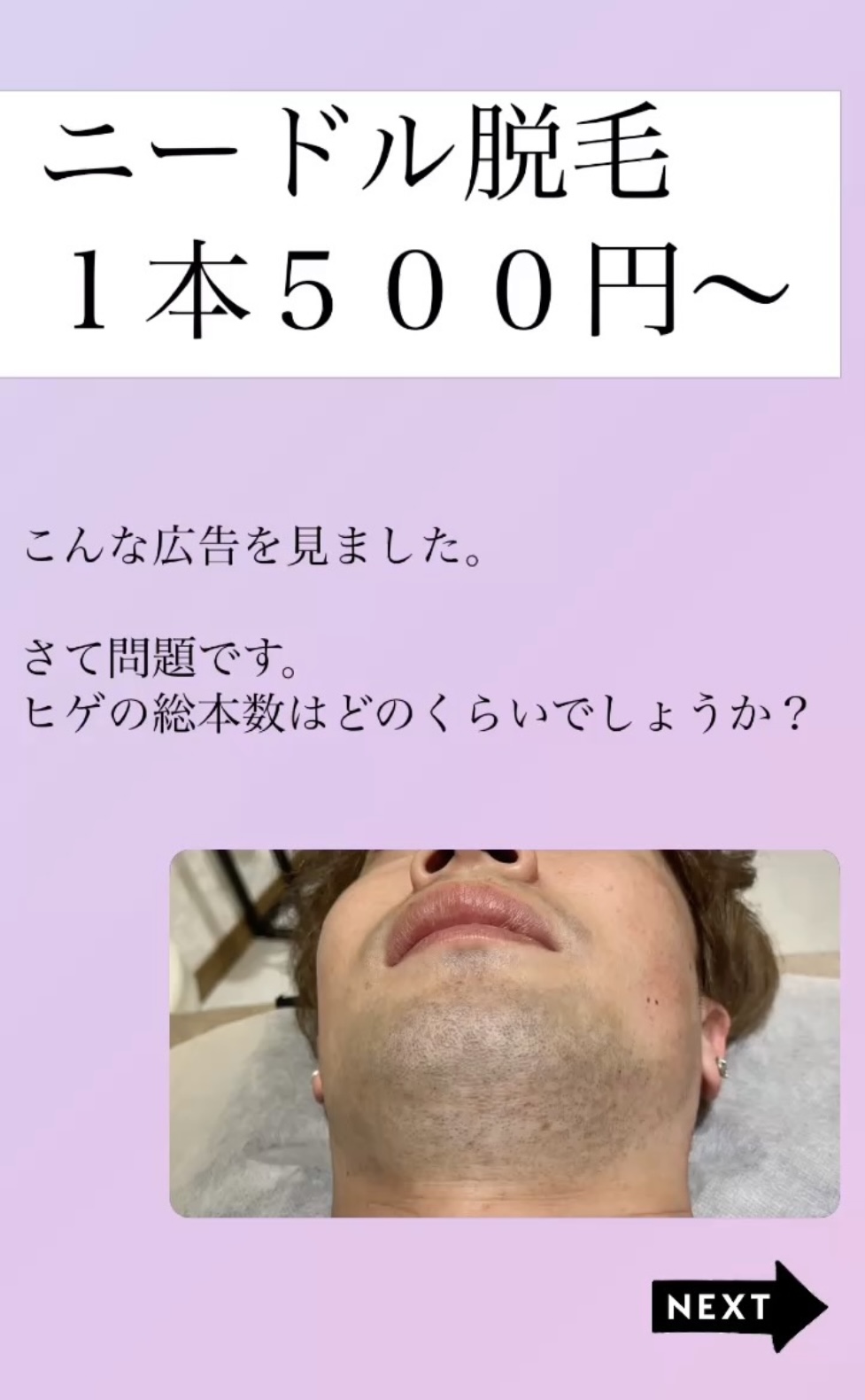 【1本500円の脱毛は安い？】ヒゲの総本数✅