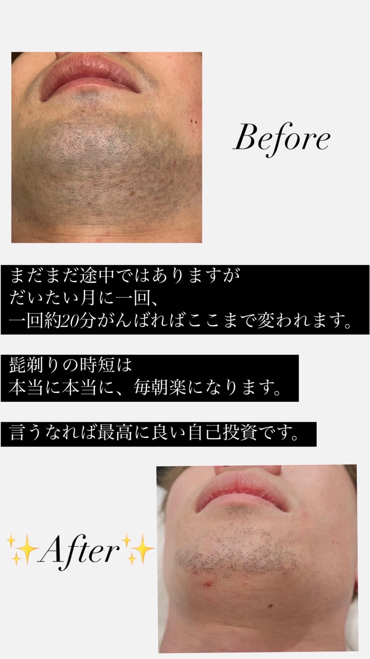 【最高の自己投資】ヒゲ脱毛で毎朝が楽になります！