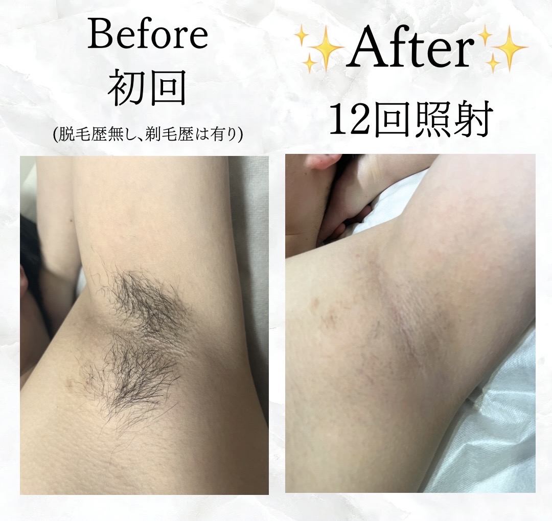 【メンズ脱毛】Before／After脇脱毛