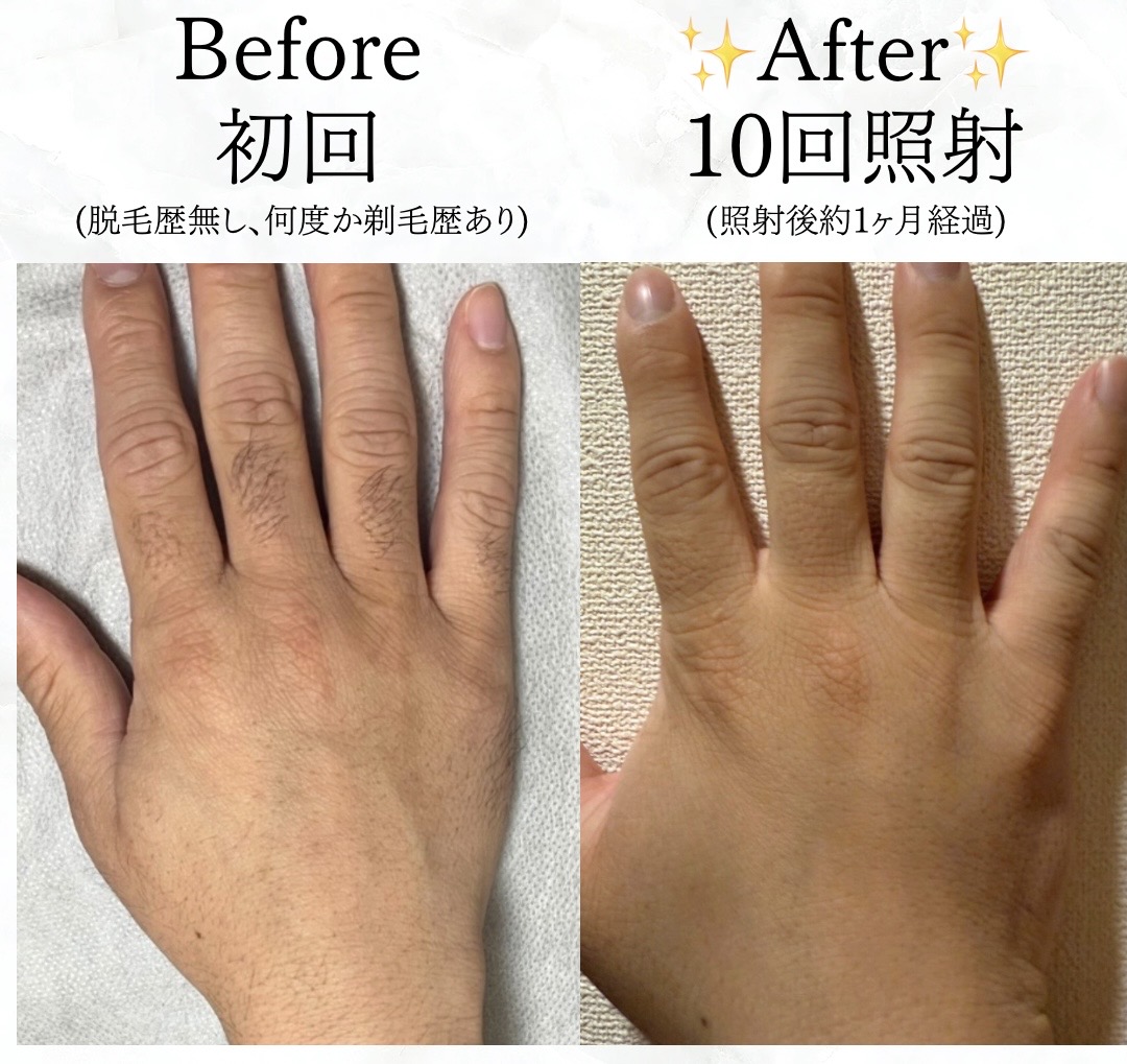 【メンズ脱毛】手の甲・指脱毛のBefore/After